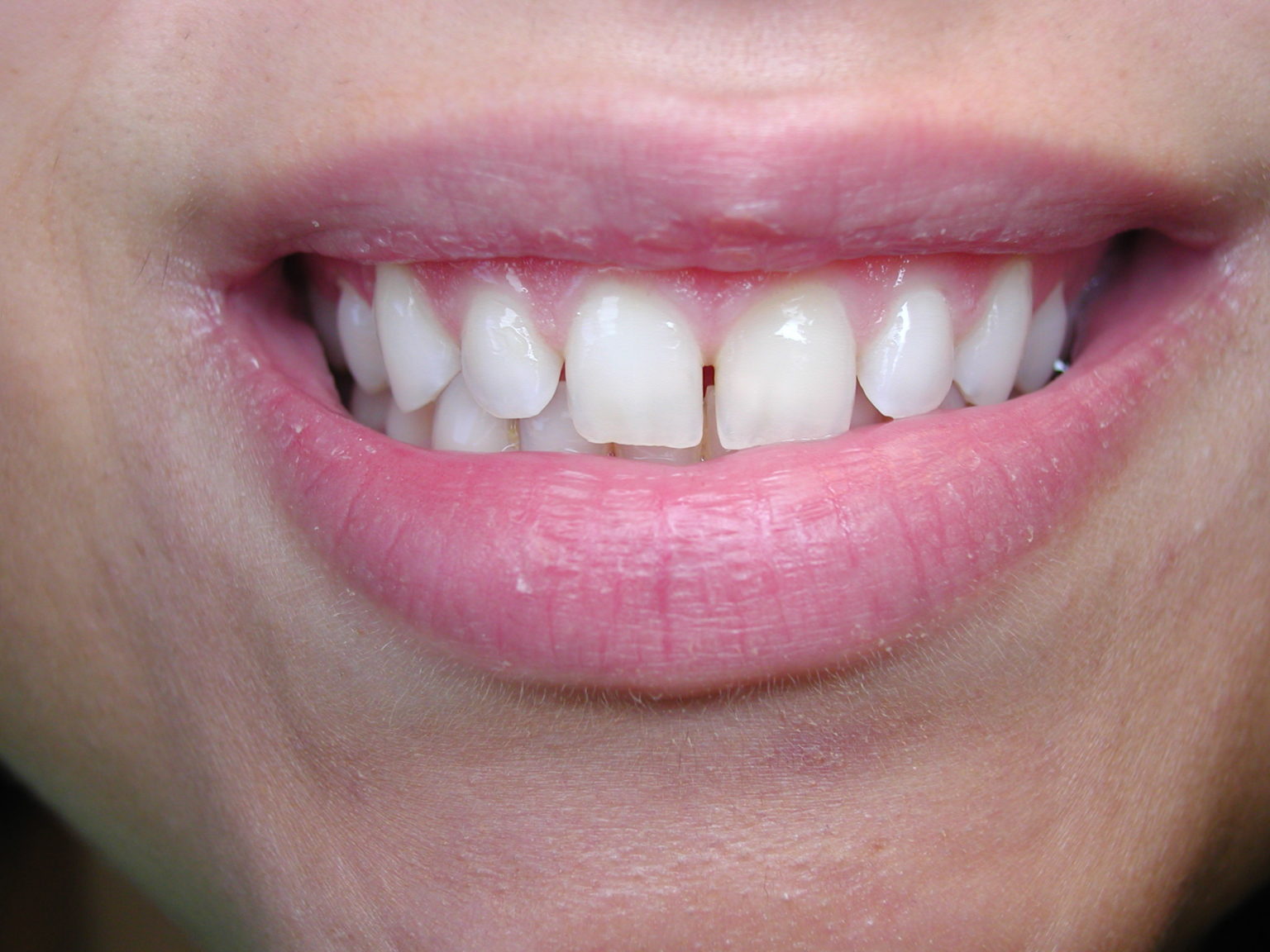 Dental Bonding A Relatively Inexpensive Way To Close Gaps Between Front Teeth Dr Mark